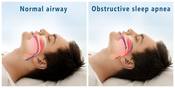 sleep apnea image